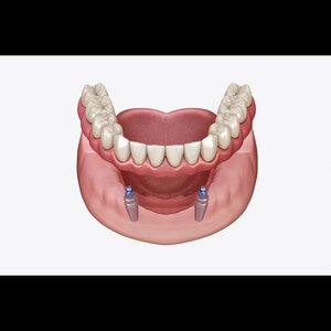 Camila prothetischemondzorg image 4