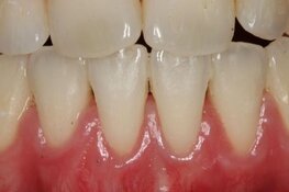 Uitnodiging lezing 18 november: Een recessie is vaak meer dan alleen ‘te weinig gingiva’.